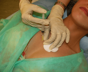 Einbringen eines Meso-Cocktails in das Brustgewebe – eine Alternative zur Hyaluronsäure-Injektion