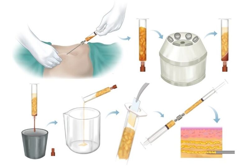 Entfernung von Fett aus Problemzonen, Verarbeitung und Injektion in das Brustgewebe