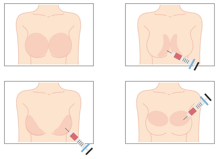 Orte zur Injektion von Hyaluronsäure in die Brust