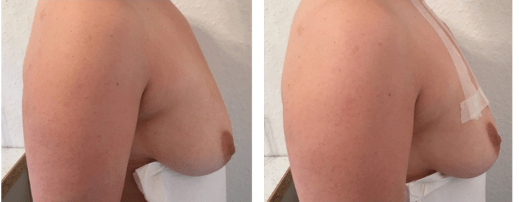 Vor und nach der Bruststraffung mit Faden