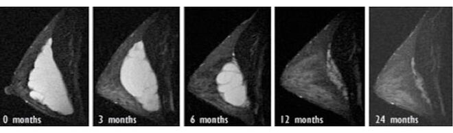 Der Prozess der Rückresorption von Hyaluronsäure in der Brust